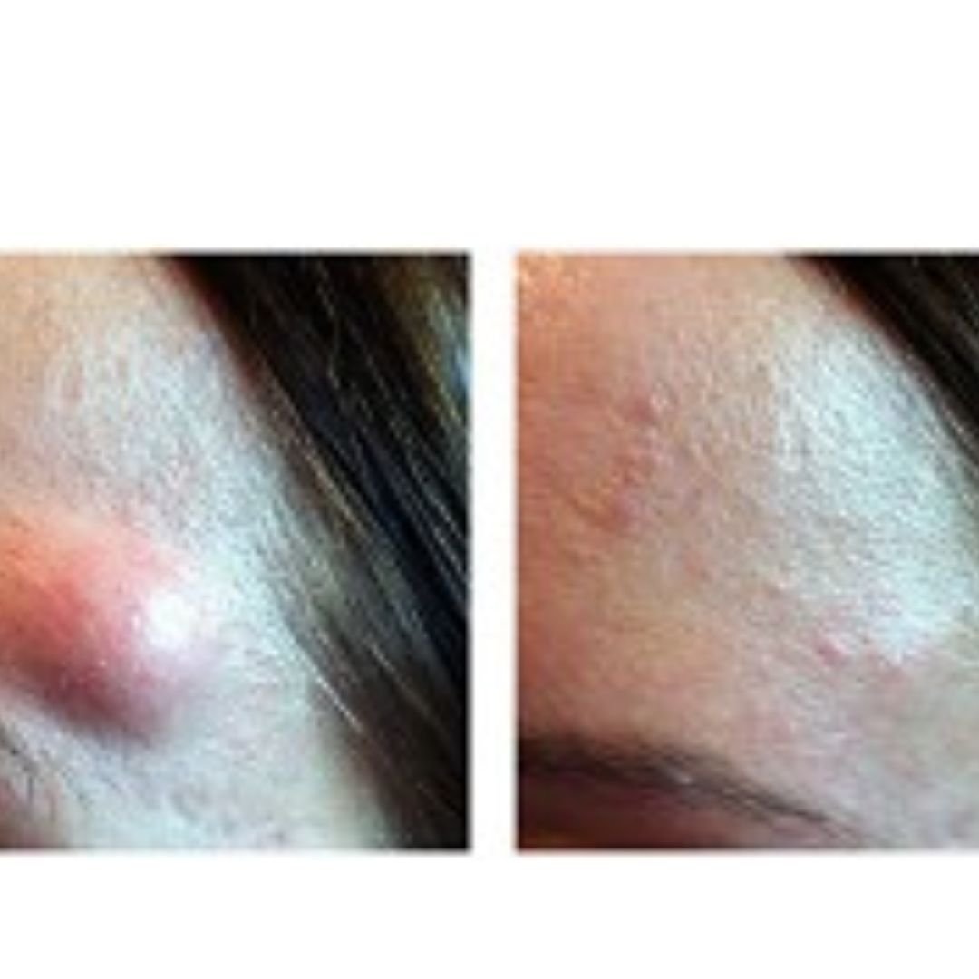 Lipoma Removal: Understanding the Procedure and Benefits - Tesla Bookmarks