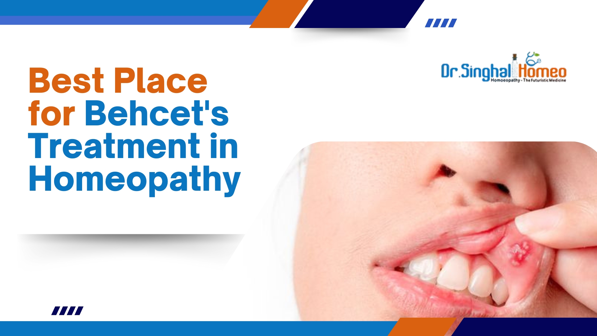 Exploring Homeopathic Treatment for Behcet’s Disease: A Natural Approach to Healing – health