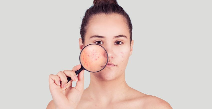 Acne Scar Treatment in Indirapuram: Restore Your Skin's Confidence
