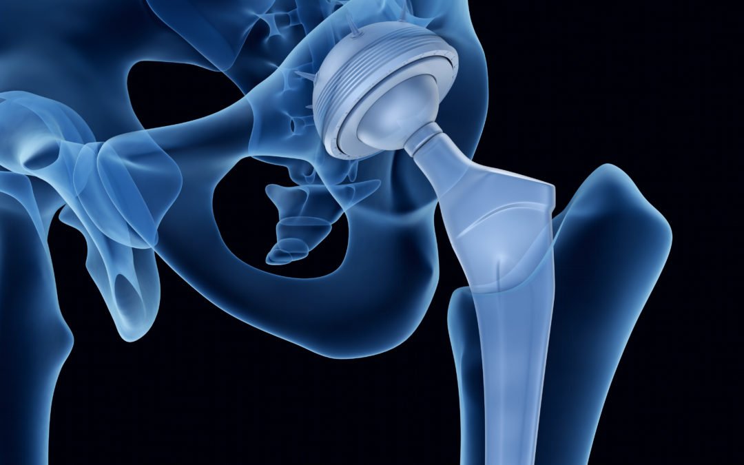 Hip Replacement Surgery Cost In India - 2025
